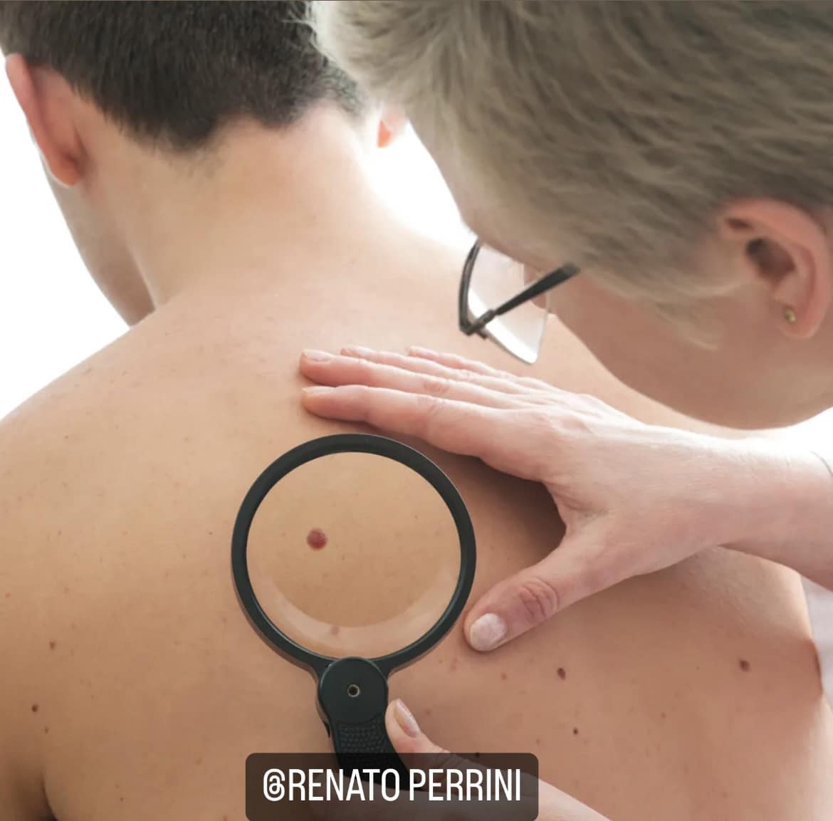 1 MELANOMA
